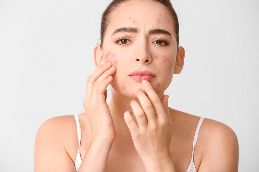 7 Effective Ways to Get Rid of Acne Naturally