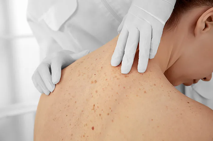 Note, these are the steps to treat skin cancer