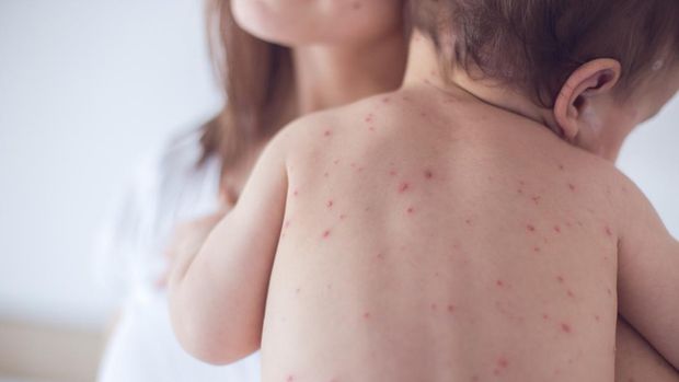 5 Ways to Treat Chicken Pox so it Doesn’t Get More, Effective and Doesn’t Leave Scars